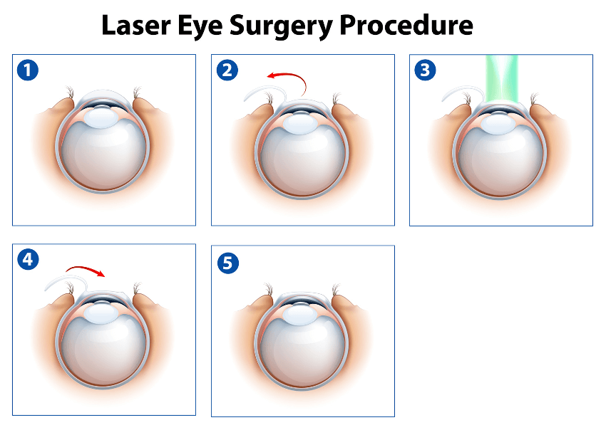 Augenlasern in Hamburg - Augenklinik