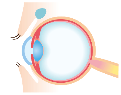 Augenlasern in Heidelberg - Augenklinik