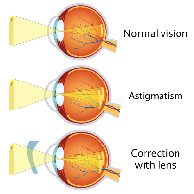 Augenlasern trotz Hornhautverkrümmung (Astigmatismus/Stabsichtigkeit)