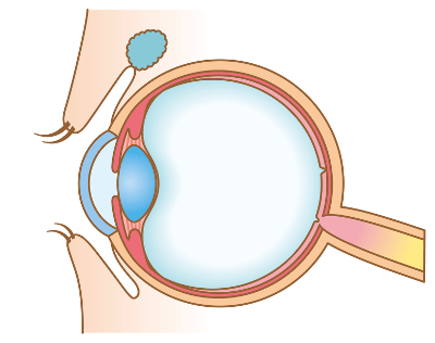 Augenlasern in Linz - Augenklinik