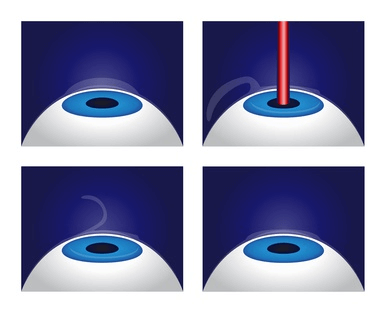 Augenlasern Methoden: Was sind die besten Verfahren?