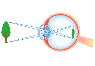 Augenlasern in Österreich - Augenklinik