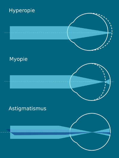 Augenlasern in Stuttgart - Augenklinik