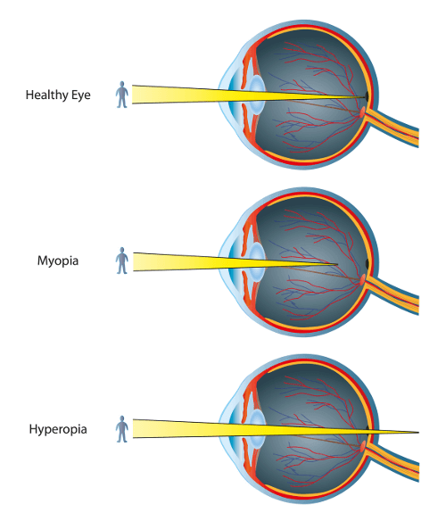 Augenlasern bei Weitsichtigkeit und Kurzsichtigkeit