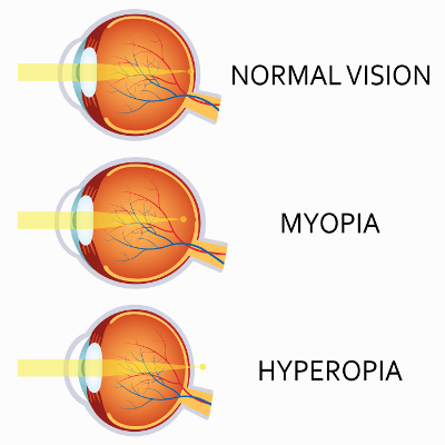 Weitsichtig (Hyperopie) und Kurzsichtig (Myopie) lasern lassen